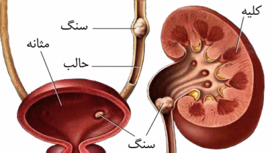 درمان سنگ کلیه با چندین روش انجام میشود