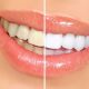 روش‌هایی ساده برای سفید کردن دندان