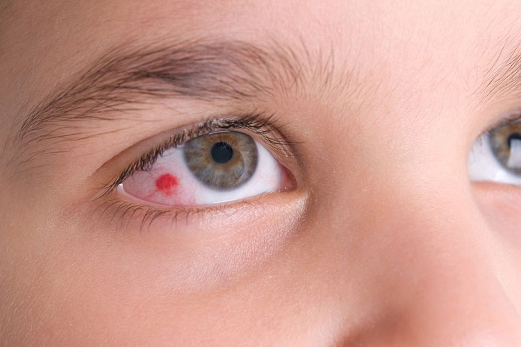 عمل ناخنک چشم با لیزر/ درمان ناخنک چشم با لیزر/ ناخنک چشم در کودکان