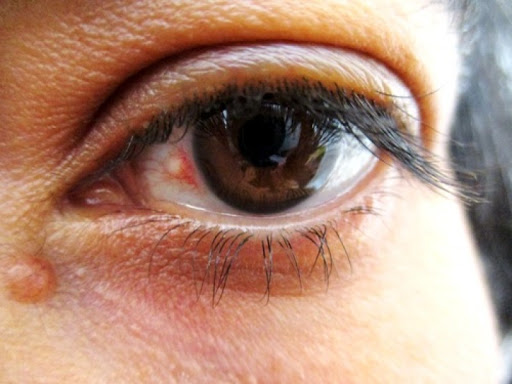 ناخنک چشم چیست/ ناخنک چشم و درمان/ جراحی ناخنک چشم با لیزر/ 
