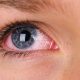 علت قرمزی چشم چیست و راه درمان در خانه